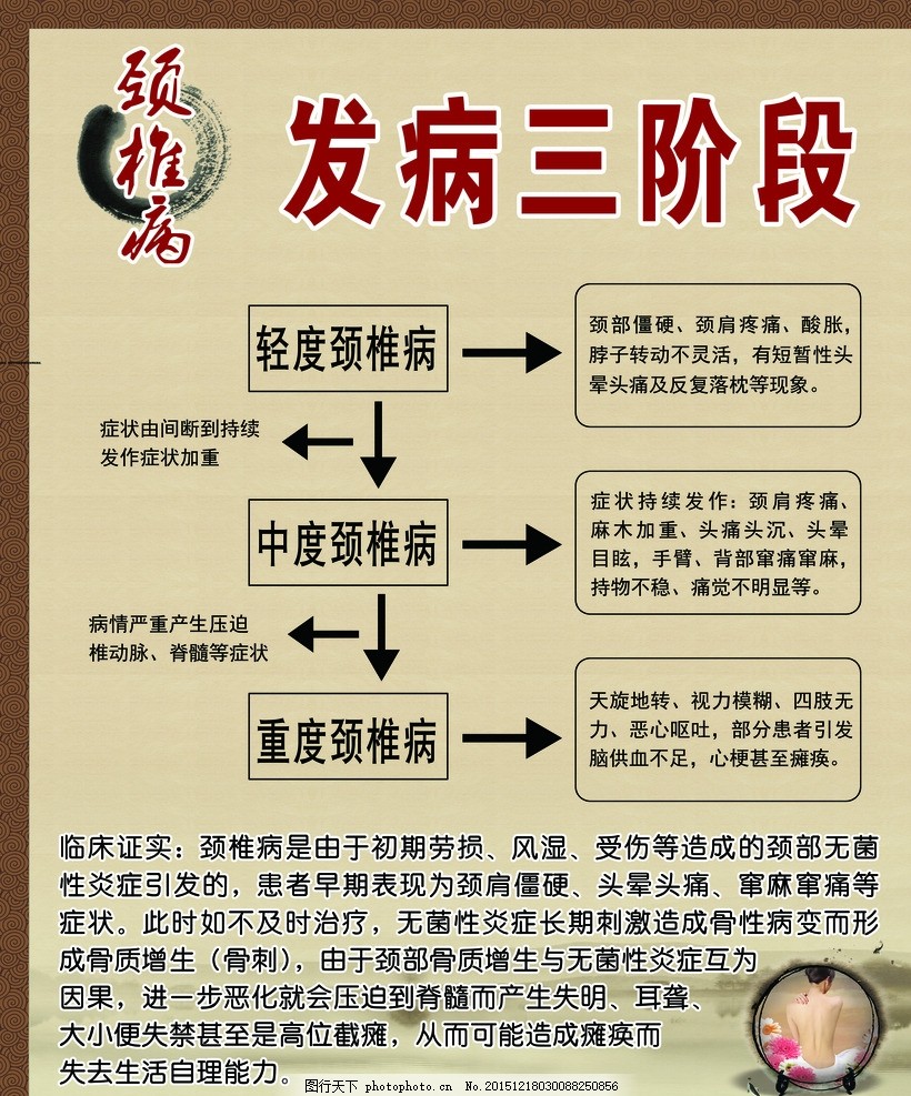 颈椎病发病三阶段